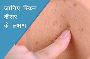 जानिए स्किन कैंसर के लक्षण