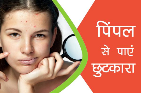 पिंपल से पाएं छुटकारा