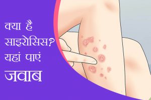 information about psoriasis