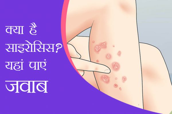 सोराइसिस की सही जानकारी है जरूरी