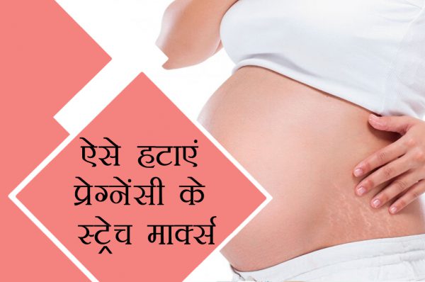 प्रेग्नेंसी के स्ट्रेच मार्क्स हटाना चाहती हैं तो ये खबर आपके लिए है