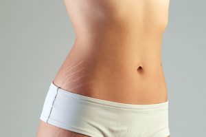 Stretch-Marks