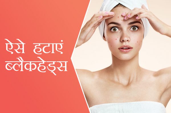 ऐसे हटाएं ब्लैकहेड्स