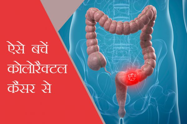 कोलोरैक्टल कैंसर बचाव ही उपाय