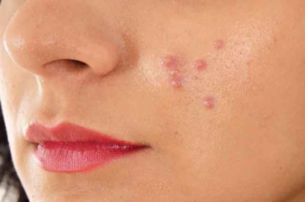pimples