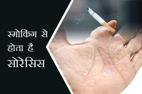 स्मोकिंग करने वालों को है सोराइसिस का खतरा