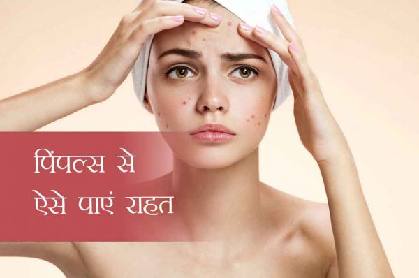 पिंपल्स से राहत पाने के लिए आजमाएं ये 4 टिप्स