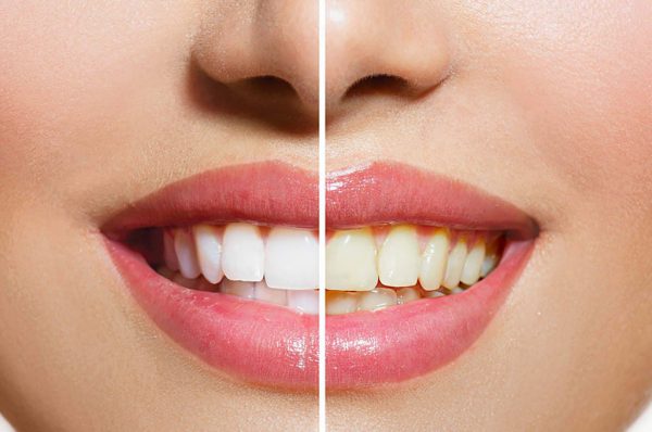5 टिप्स: मुंह की बदबू  से पाए ऐसे छुटकारा…