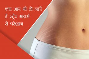 stretch marks