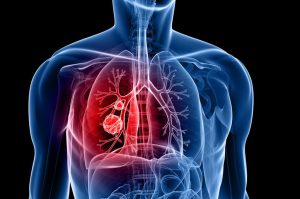 lung-cancer