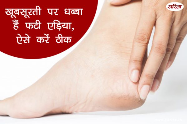खूबसूरती पर धब्बा हैं फटी एड़िया, ऐसे करें ठीक