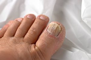 नाखूनों से जानें हेल्थ का राज : ये बदलाव दिखे तो हो जाएं अलर्ट
