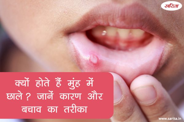 Winter Special: क्यों होते हैं मुंह में छाले? जानें कारण और बचाव का तरीका