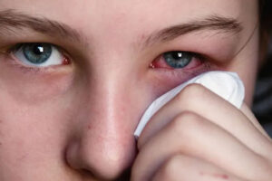 Conjunctivitis : आंखों के सामान्य रोग से कैसे बचें ?