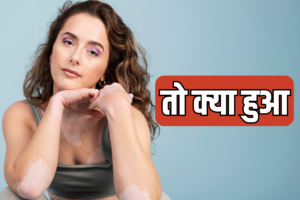 विटिलिगो से निराशा क्यों : मान लीजिए कि दाग अच्छे हैं