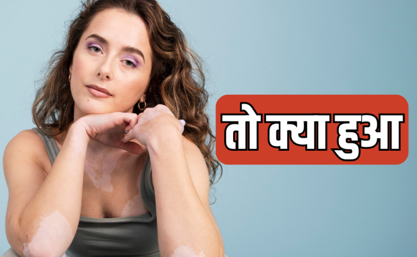 विटिलिगो से निराशा क्यों : मान लीजिए कि दाग अच्छे हैं