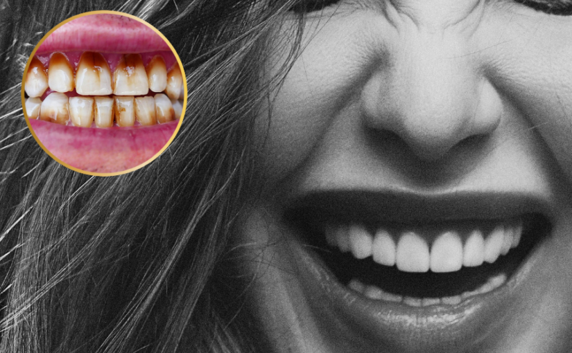 Dental Problem : मेरे दांत टेढ़ेमेढ़े, पीले, आधे टूटे हैं.  मुझे शर्मिंदगी होती है,
