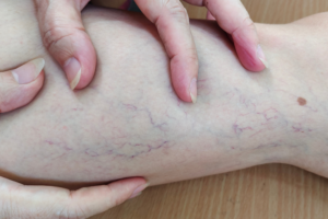 Varicose veins के इलाज का बेहतर तरीका क्या है?