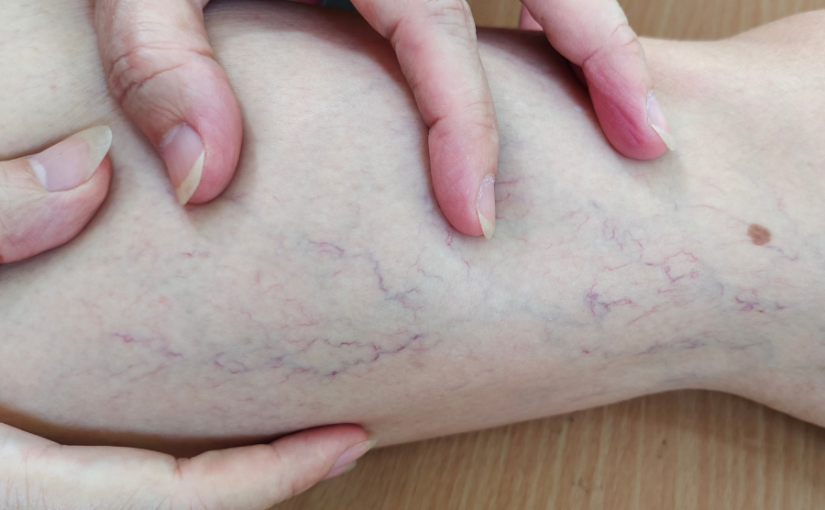 Varicose veins के इलाज का बेहतर तरीका क्या है?