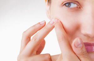How to remove pimples, pimple marks, scars & pimple spots